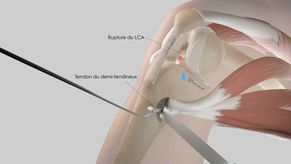 Peut-on réopérer un ligament croisé déjà opéré ?
