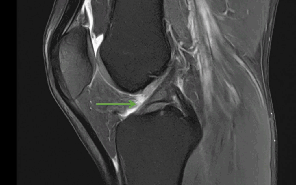 IRM et ligament croisé antérieur : comment faire le diagnostic