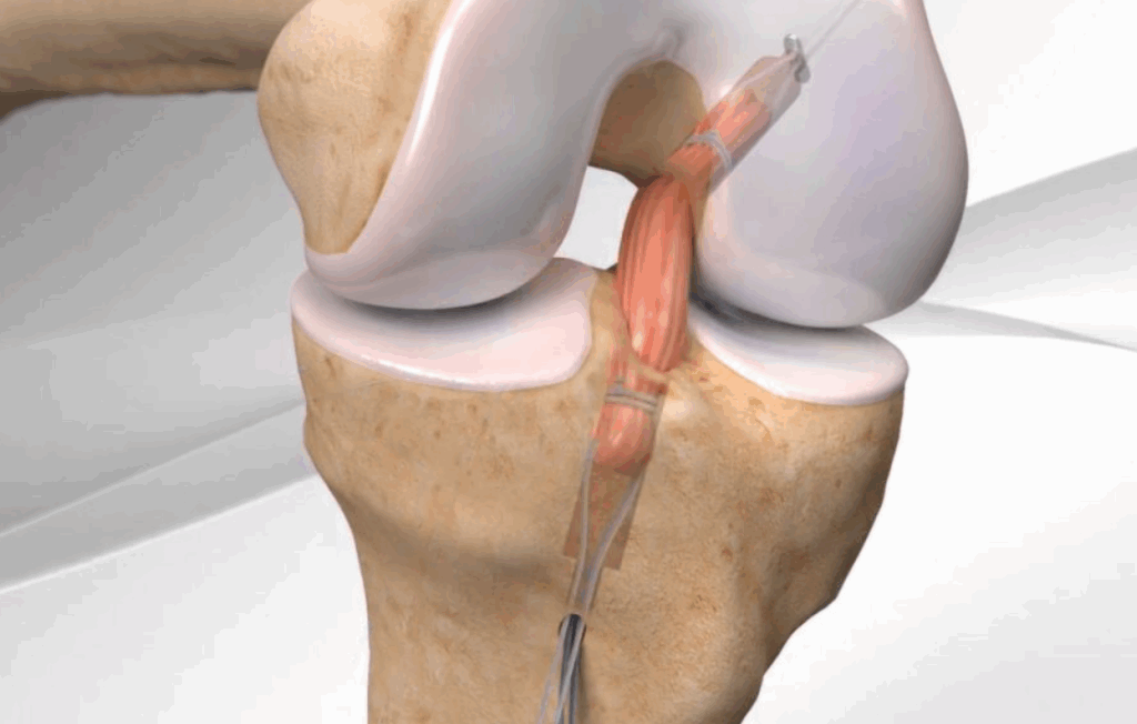 À quoi sert le ligament croisé dans la stabilité du genou ?