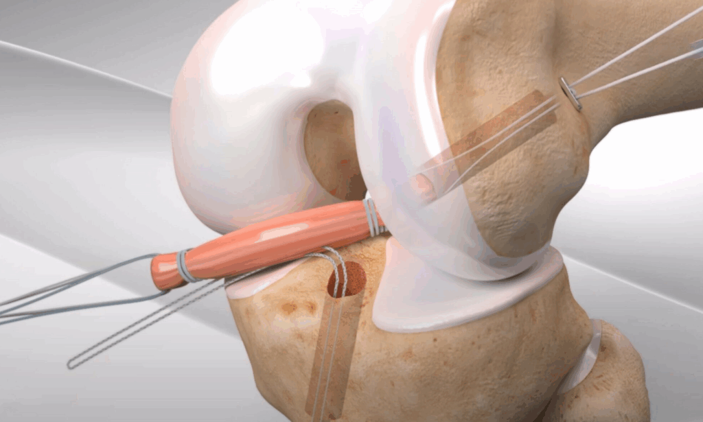 Qu’est-ce qu’une plastie antéro-latérale et pourquoi l’associer à la chirurgie du ligament croisé ?