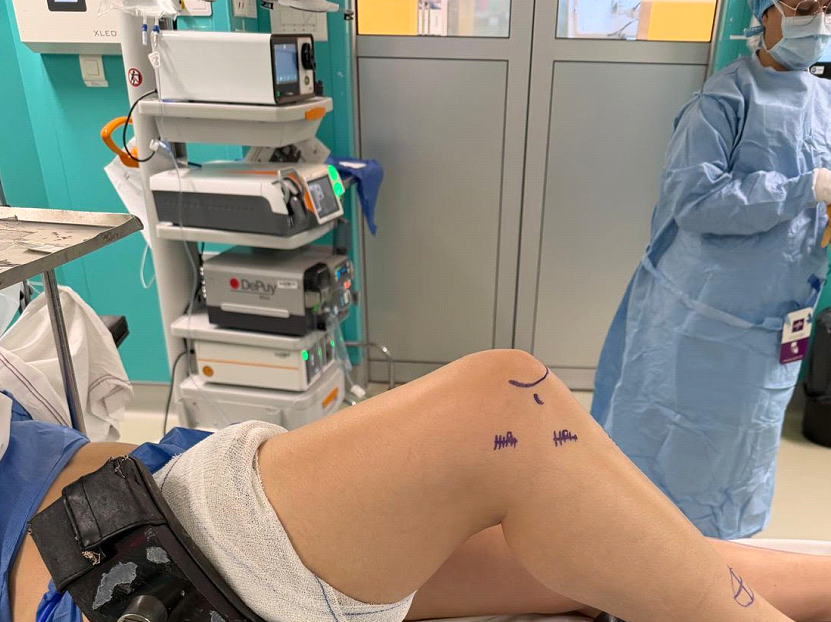 Les cicatrices après une reconstruction du LCA – à quoi s’attendre ?