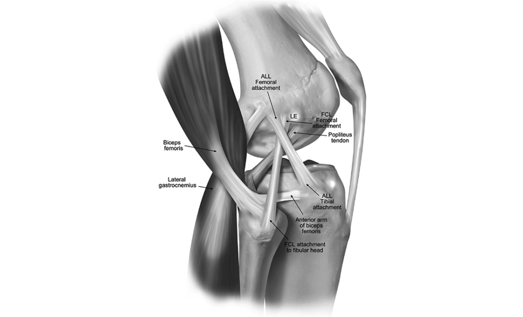 Qu’est-ce qu’une plastie antéro-latérale et pourquoi l’associer à la chirurgie du ligament croisé ?